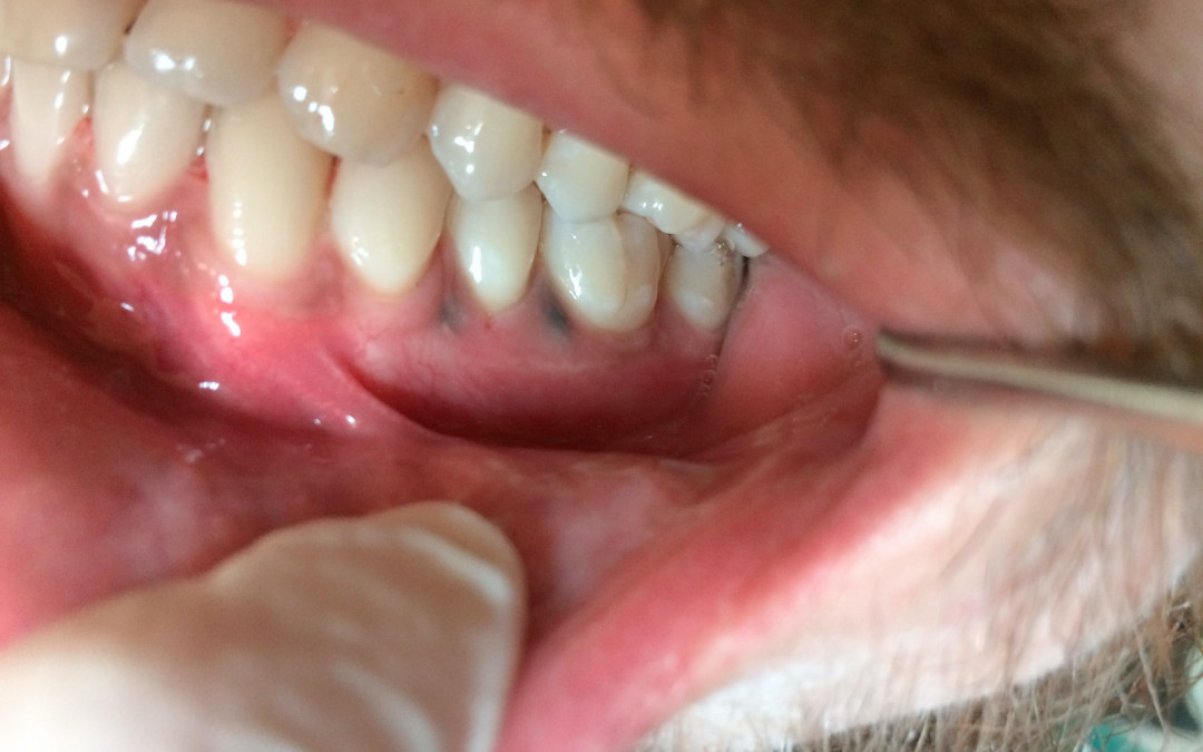 Il tumore del cavo orale: quando, come e perché?